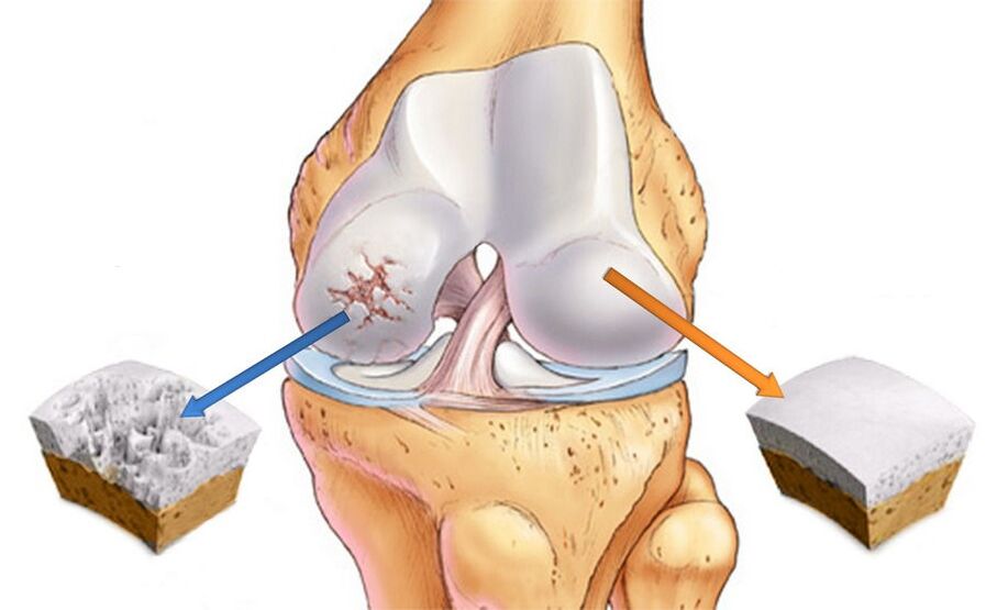 Arthrose des Kniegelenks und gesunder Knorpel