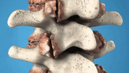 Osteophyten der Wirbel - pathologische Klassen, die die Nerven und Blutgefäße schädigen