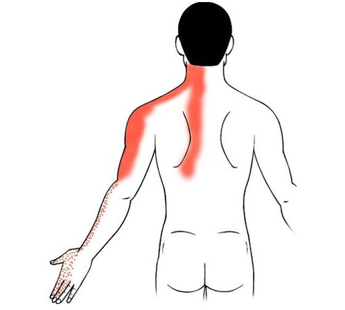 zervikale Osteochondrose als Ursache für Schmerzen in den Fingergelenken
