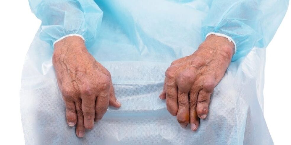 Infektiöse Arthritis ist eine Erkrankung, die durch ständige Schmerzen und Veränderungen der Fingergelenke gekennzeichnet ist.